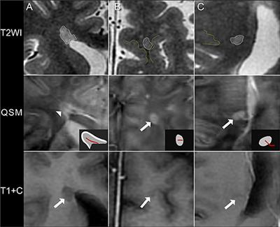 The Distributional Characteristics of Multiple Sclerosis Lesions on Quantitative Susceptibility Mapping and Their Correlation With Clinical Severity